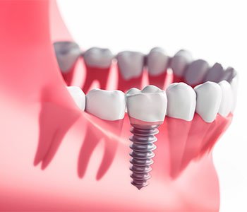 The lifespan of teeth implants