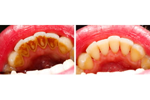 gum-disease3