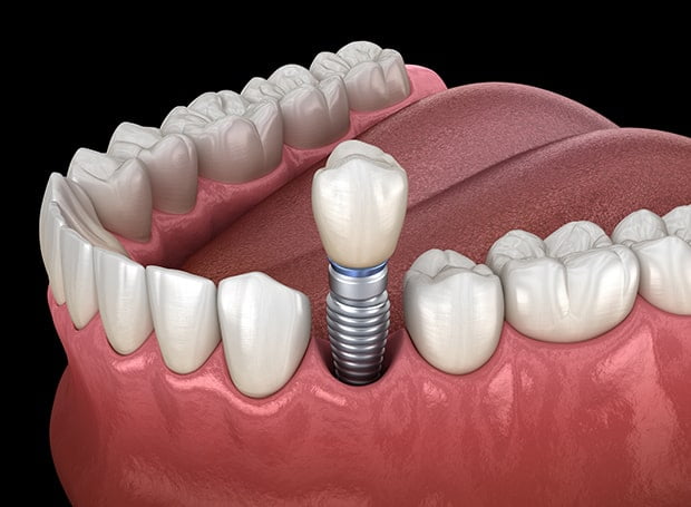 dental-implant-process-croydon