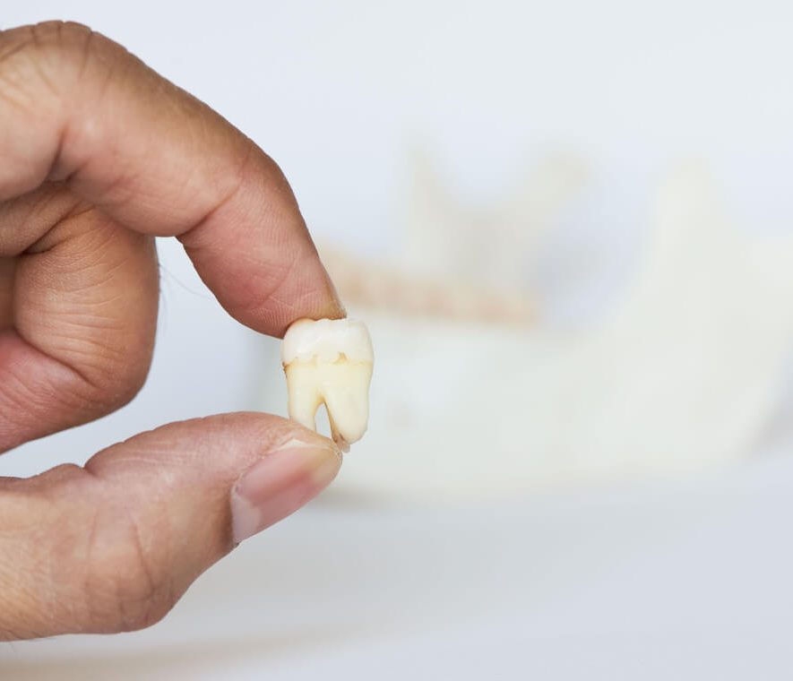 when do wisdom teeth come in