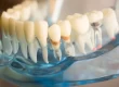 How To Remove Plaque From Dentures